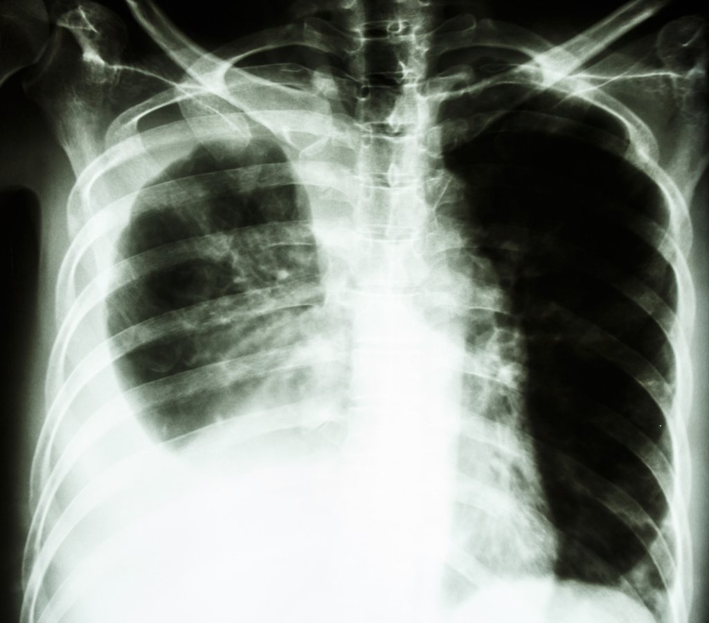 диагностика лёгких